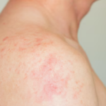 North london measles outbreak