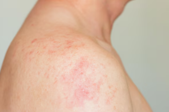 North london measles outbreak