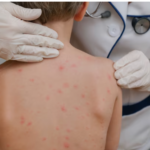 Measles Near 1000 Cases , How a Preventable Disease Roared Back