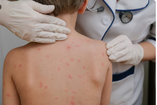 Measles Near 1000 Cases , How a Preventable Disease Roared Back