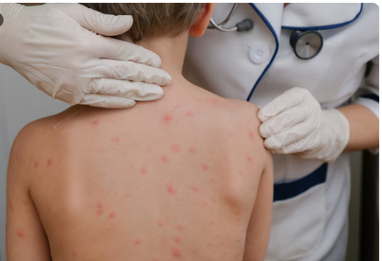 Measles Near 1,000 Cases , How a Preventable Disease Roared Back